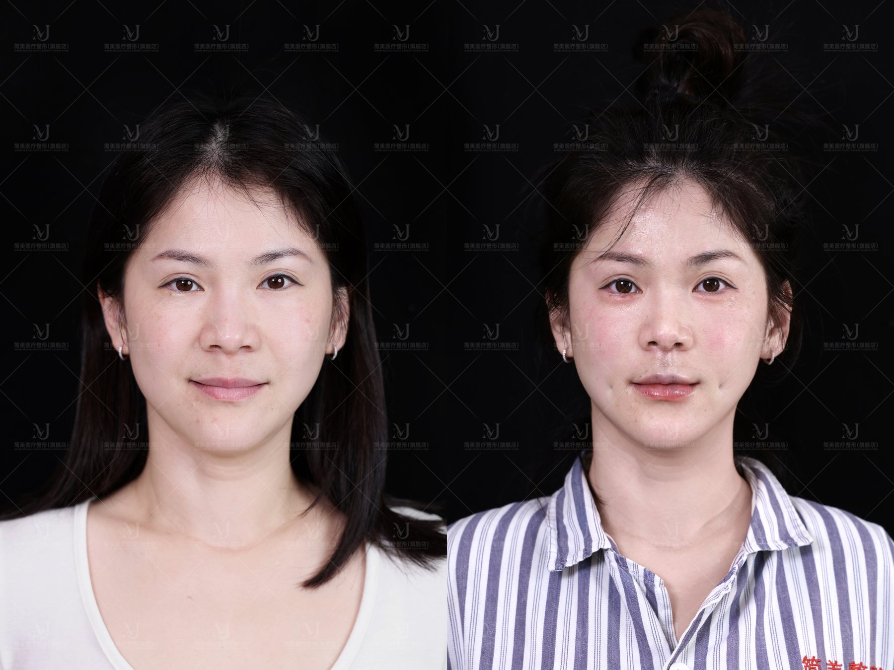 杜氏多维灵动美窝术与口周美学案例展示